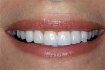 After Veneers