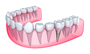 Dental Implants Melrose, MA