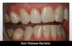 Gum Disease Bacteria