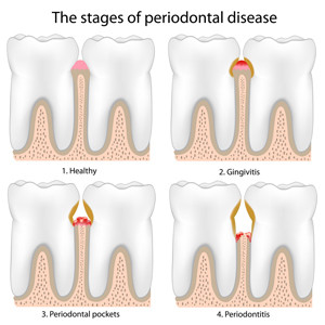 Stages-of-Periodontal-Disease