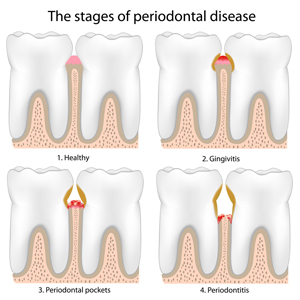 Stages-of-Periodontal-Disease