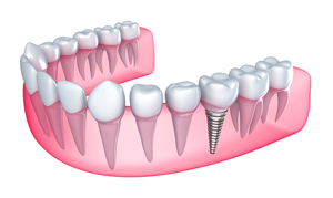 Dental Implants Malden, MA