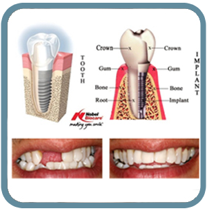 Implant Dentist Melrose, MA