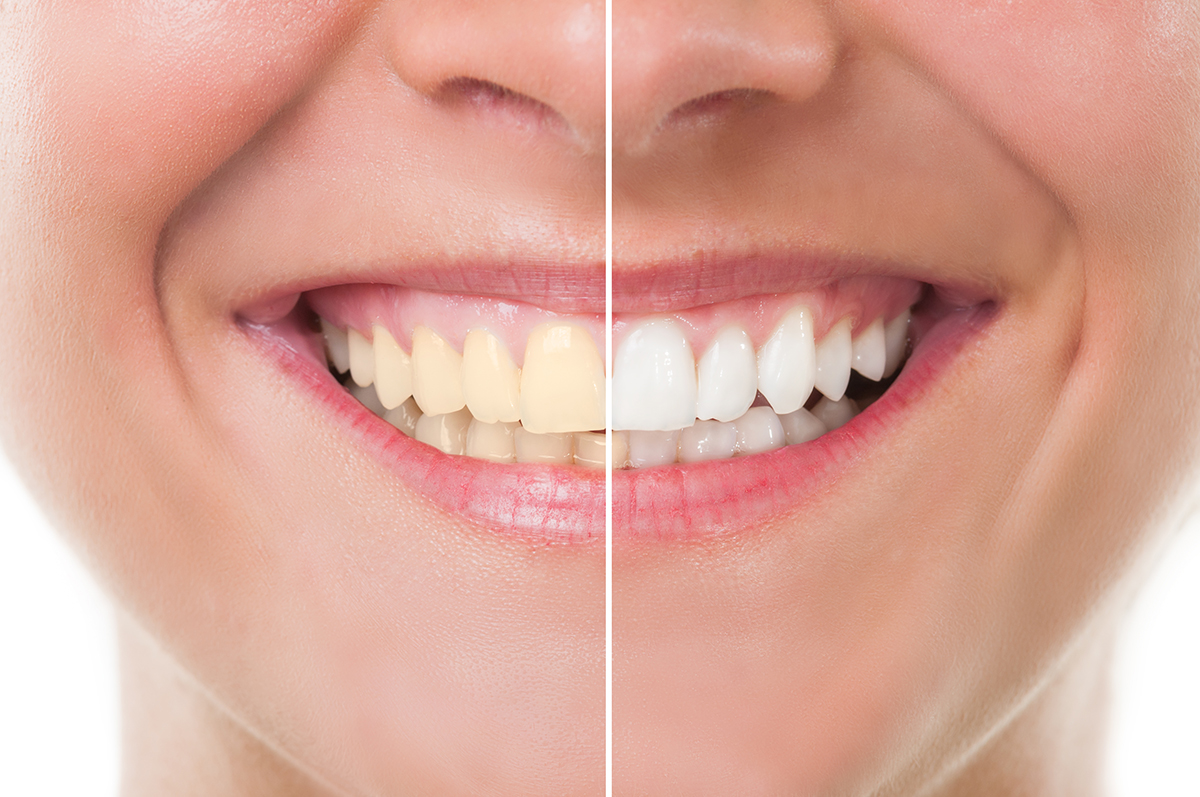 Perfect woman smile before and after whitening. Dental care and periodic exam concept
